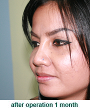 plastic_surgery_augmentation_rhinoplasty